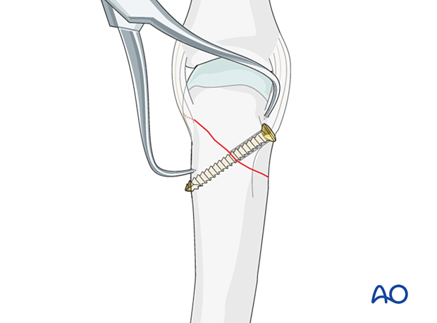 Lag screw fixation with neutralization plate of an oblique metacarpal fracture – lag screw insertion