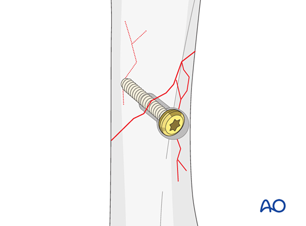 Lag screw fixation with neutralization plate of an oblique metacarpal fracture – fissure lines