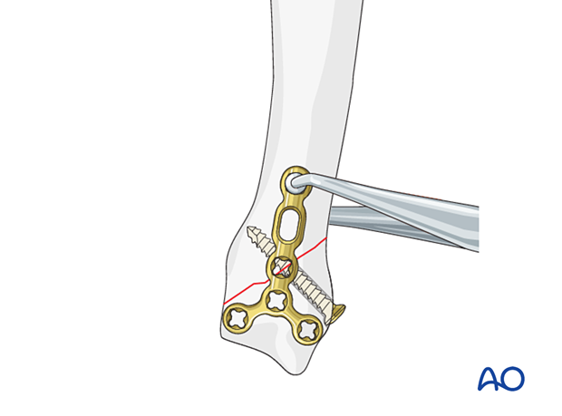 Lag screw fixation with neutralization plate of an oblique metacarpal fracture – plate positioning