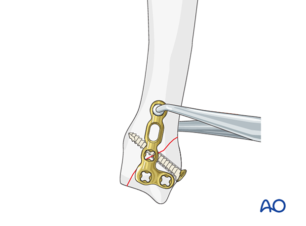 Lag screw fixation with neutralization plate of an oblique metacarpal fracture – plate positioning