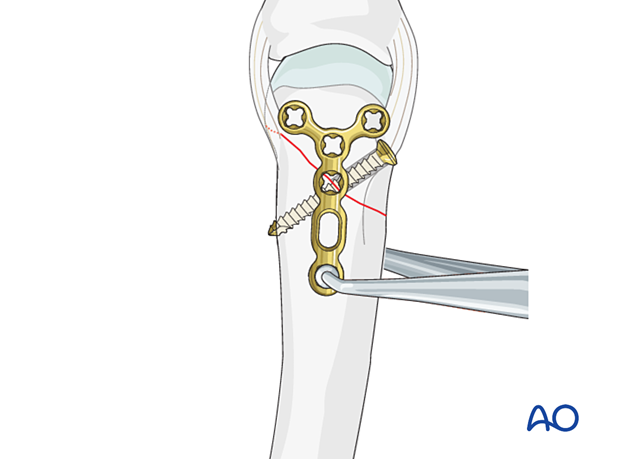 Lag screw fixation with neutralization plate of an oblique metacarpal fracture – plate positioning