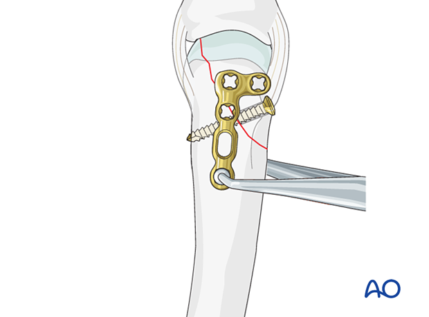 Lag screw fixation with neutralization plate of an oblique metacarpal fracture – plate positioning