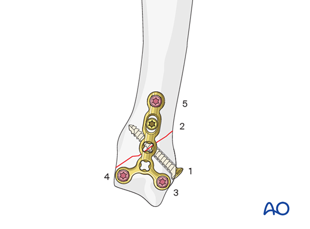 Lag screw fixation with neutralization plate of an oblique metacarpal fracture – order of screw insertion