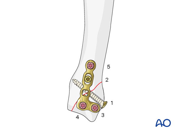 Lag screw fixation with neutralization plate of an oblique metacarpal fracture – order of screw insertion