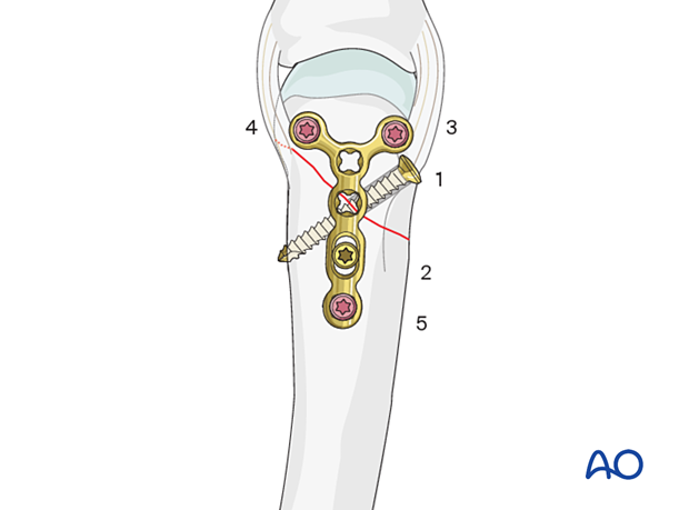 Lag screw fixation with neutralization plate of an oblique metacarpal fracture – order of screw insertion