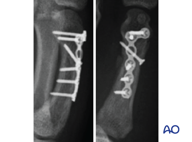 Lag screw fixation with neutralization plate of an oblique metacarpal fracture – case