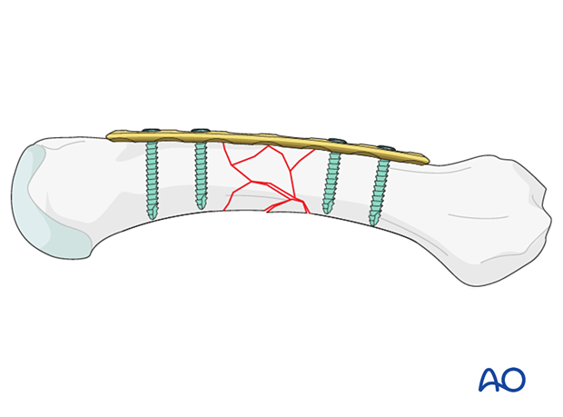 Bridge plating for Wedge or multifragmentary fracture of the diaphysis