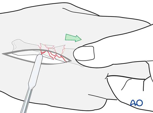 Reduction of a multifragmentary metacarpal shaft fracture 