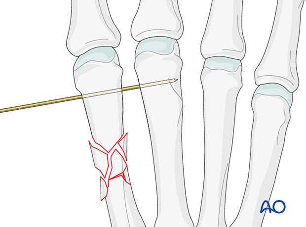 Restauration of length by K-wire fixation to an adjacent metacarpal bone