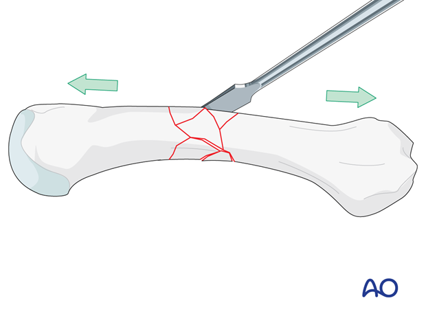 Reduction of a multifragmentary metacarpal shaft fracture