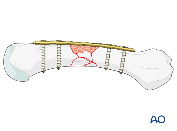 Bridge plating of a multifragmentary fracture of a metacarpal shaft with bone graft