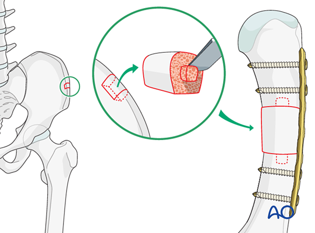 Bridge plating of a multifragmentary fracture of a metacarpal shaft with bone graft