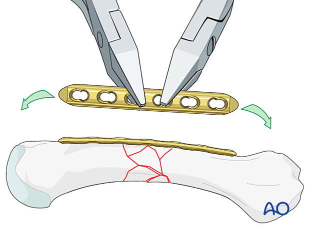 Bridge plating of a multifragmentary fracture of a metacarpal shaft – plate preparation