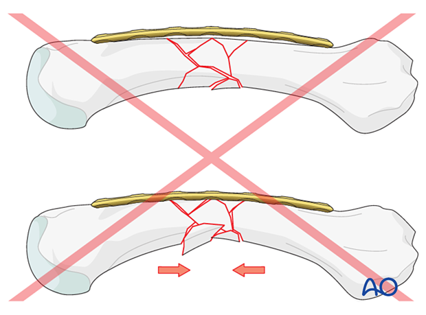 Bridge plating of a multifragmentary fracture of a metacarpal shaft – Pitfalls in plate preparation