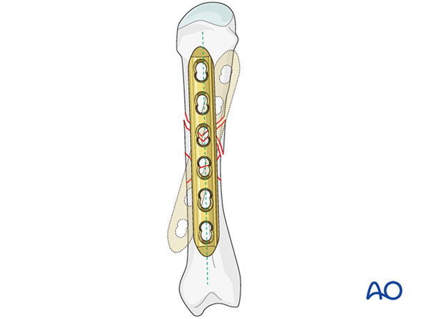 Bridge plating of a multifragmentary fracture of a metacarpal shaft – plate application