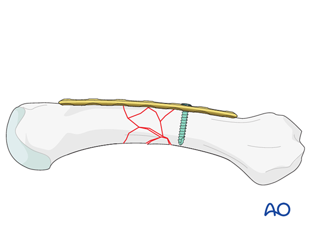 Bridge plating of a multifragmentary fracture of a metacarpal shaft – Insertion of first screw