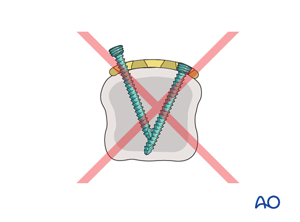 Convergent screw tracks in the application of T-plates to the metacarpal