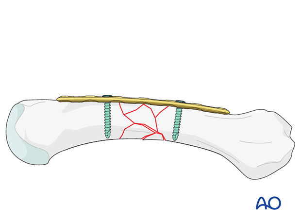 Bridge plating of a multifragmentary fracture of a metacarpal shaft – insertion of a second screw