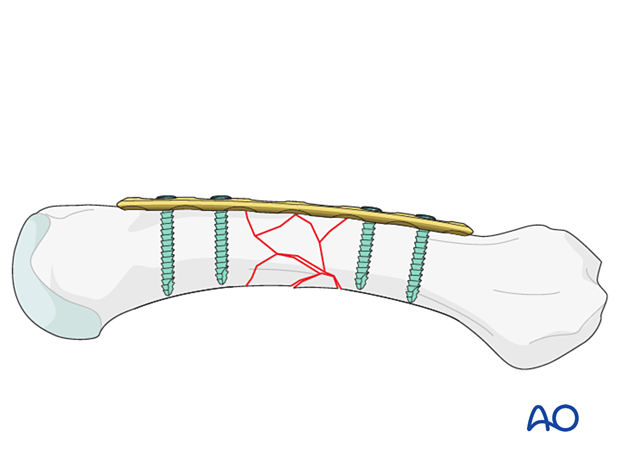 Bridge plating of a multifragmentary fracture of a metacarpal shaft