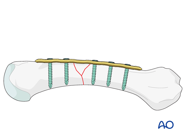 Bridge plating of a multifragmentary fracture of a metacarpal shaft