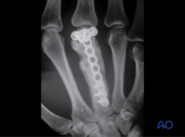 AP x-ray of a multifragmentary fracture of the 3rd metacarpal shaft stabilized with a T-plate