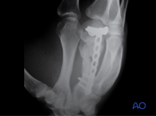 Oblique x-ray of a multifragmentary fracture of the 3rd metacarpal shaft stabilized with a T-plate