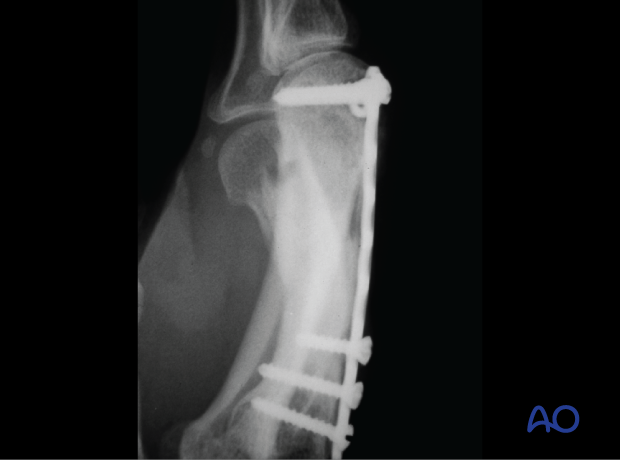 Lateral x-ray of a multifragmentary fracture of the 3rd metacarpal shaft stabilized with a T-plate