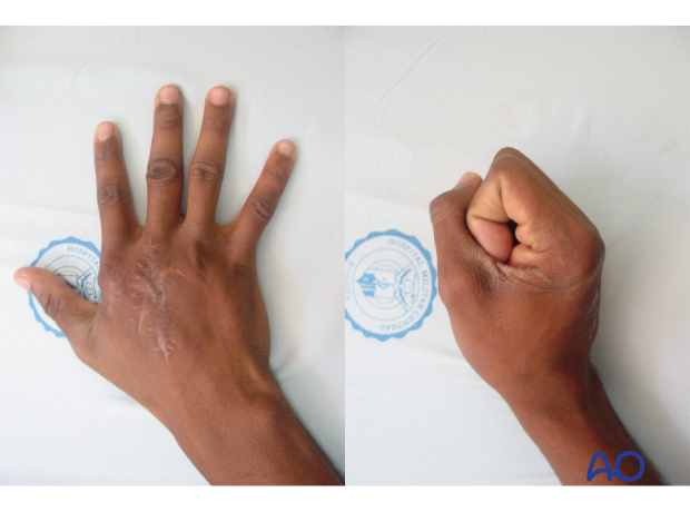 Clinical photos 3 months postoperatively of a multifragmentary fracture of the 3rd metacarpal shaft stabilized with a T-plate