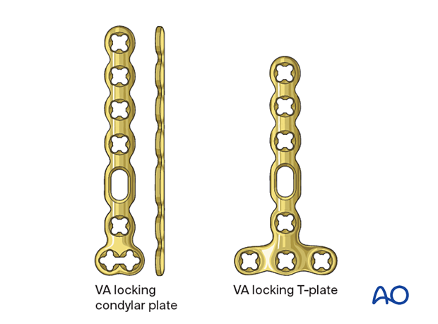 Bridge plating of a multifragmentary extraarticular fracture of the proximal metacarpal - Plate selection