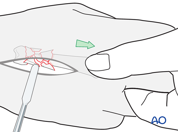 Reduction of a multifragmentary extraarticular fracture of the proximal metacarpal