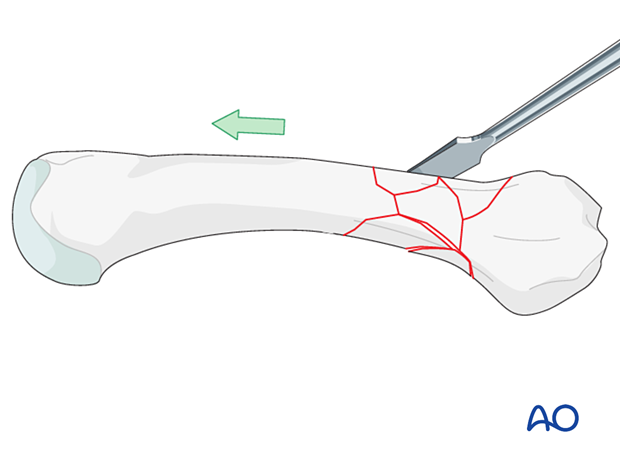 Reduction of a multifragmentary extraarticular fracture of the proximal metacarpal