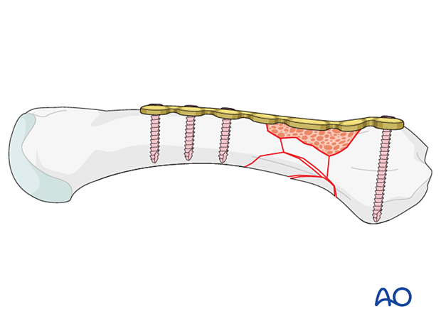 Bridge plating of a multifragmentary extraarticular fracture of the proximal metacarpal with addition of bone graft