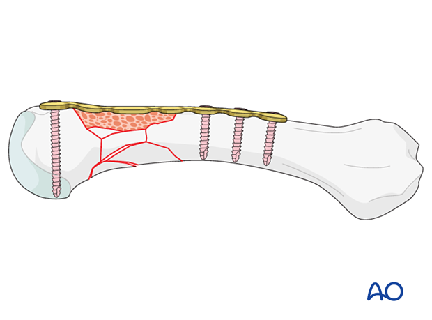 Bridge plating of a multifragmentary extraarticular fracture of the distal metacarpal with addition of bone graft