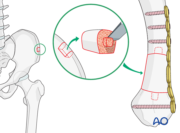 Bridge plating of a multifragmentary extraarticular fracture of the proximal metacarpal – Addition of bone graft from the iliac crest for severe bone loss