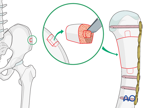 Bridge plating of a multifragmentary extraarticular fracture of the distal metacarpal – Addition of bone graft from the iliac crest for severe bone loss