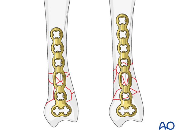 Bridge plating of a multifragmentary extraarticular fracture of the proximal metacarpal – plate position