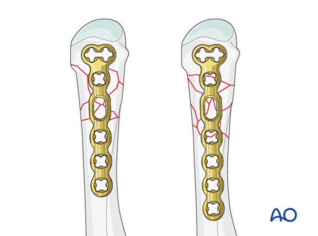 Bridge plating of a multifragmentary extraarticular fracture of the distal metacarpal – plate position