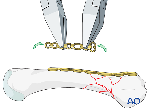 Bridge plating of a multifragmentary extraarticular fracture of the proximal metacarpal – plate contouring