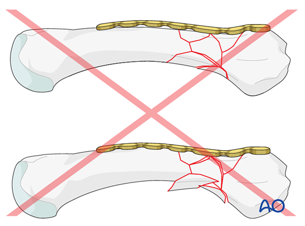 Bridge plating of a multifragmentary extraarticular fracture of the proximal metacarpal – pitfall with overbending the plate