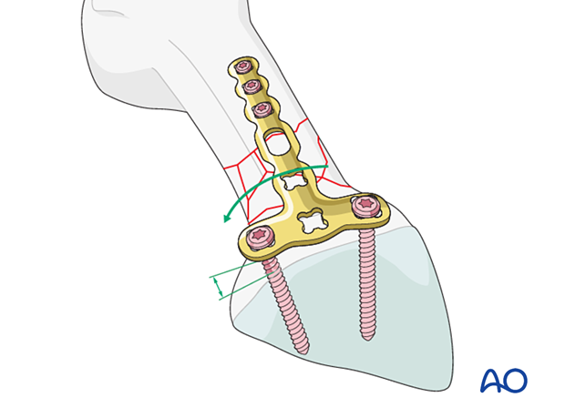 Bridge plating of a multifragmentary extraarticular fracture of the proximal metacarpal – contouring around the articular block