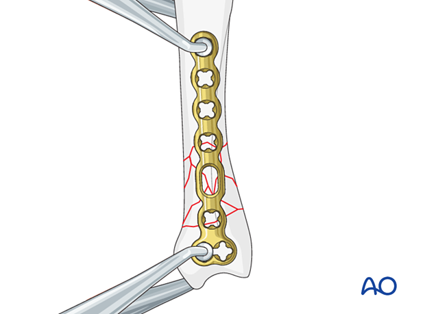 Bridge plating of a multifragmentary extraarticular fracture of the proximal metacarpal – Plate application