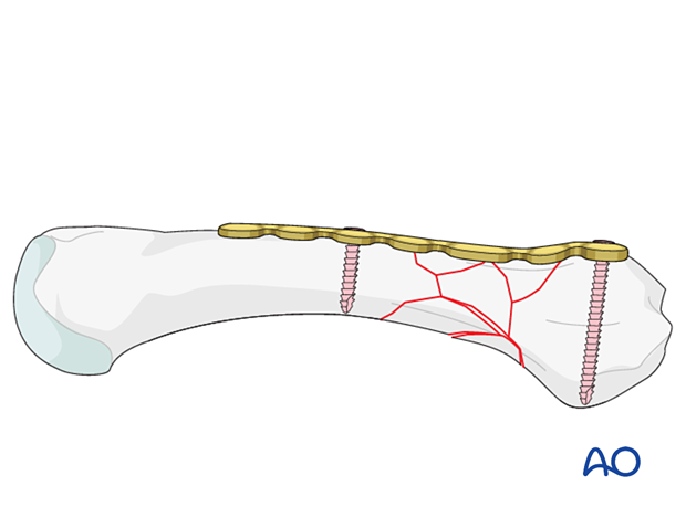 Bridge plating of a multifragmentary extraarticular fracture of the proximal metacarpal – screw insertion in both main fragments