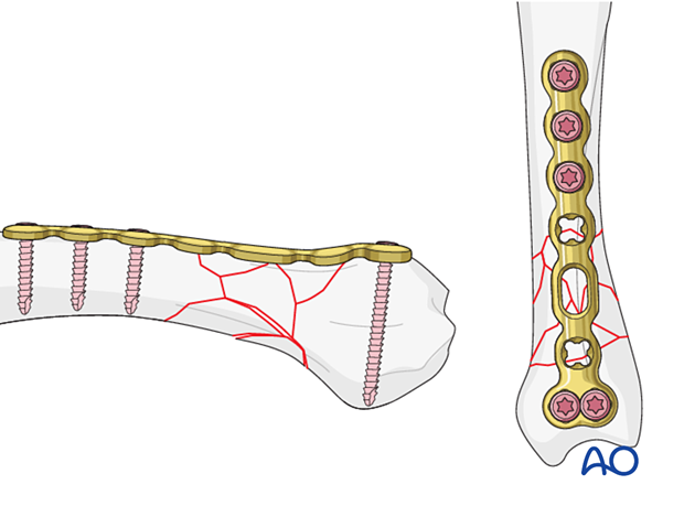 Bridge plating of a multifragmentary extraarticular fracture of the proximal metacarpal