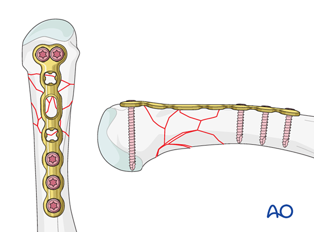 Bridge plating of a multifragmentary extraarticular fracture of the distal metacarpal