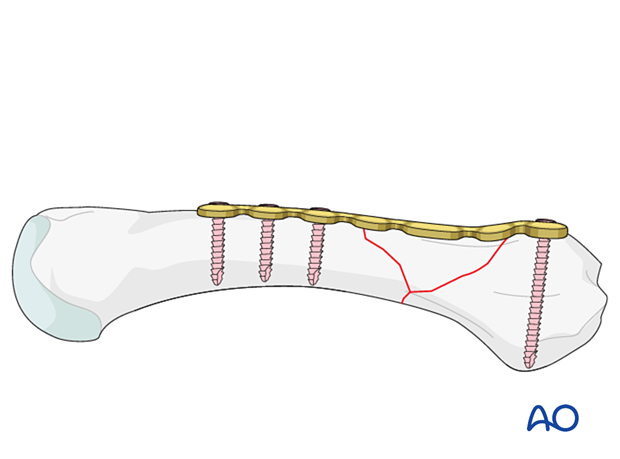 Bridge plating of a wedge extraarticular fracture of the proximal metacarpal