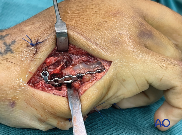 T-plate fixation of a multifragmentary extraarticular fracture of the 5th metacarpal base