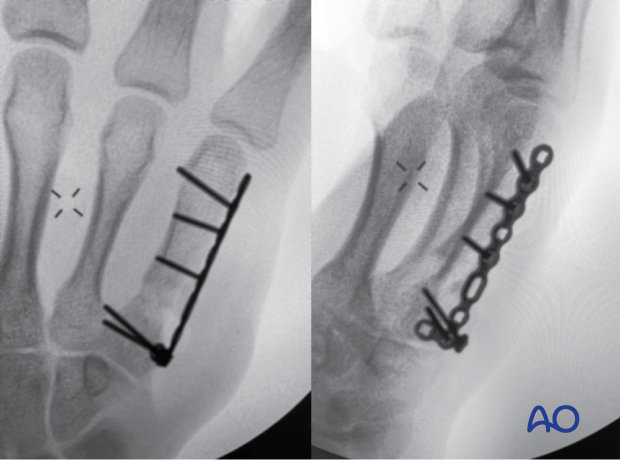 AP and lateral intraoperative images of T-plate fixation of a multifragmentary extraarticular fracture of the 5th metacarpal base