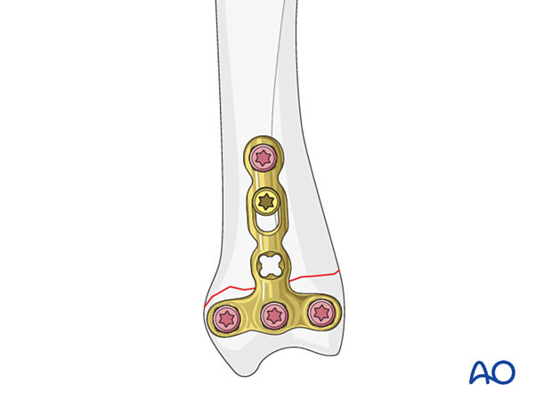 Compression with a T-plate of a transverse extraarticular fracture of the metacarpal base