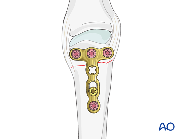 Compression with a T-plate of a transverse extraarticular fracture of the metacarpal head