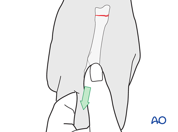 Reduction by manual traction of a transverse extraarticular fracture of the 3rd metacarpal base